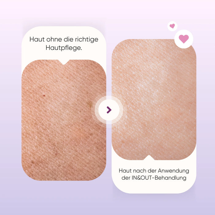 Close-up vergelijking van de huid: zonder de juiste verzorging en na de anti-rimpel gezichtsbehandeling IN & OUT